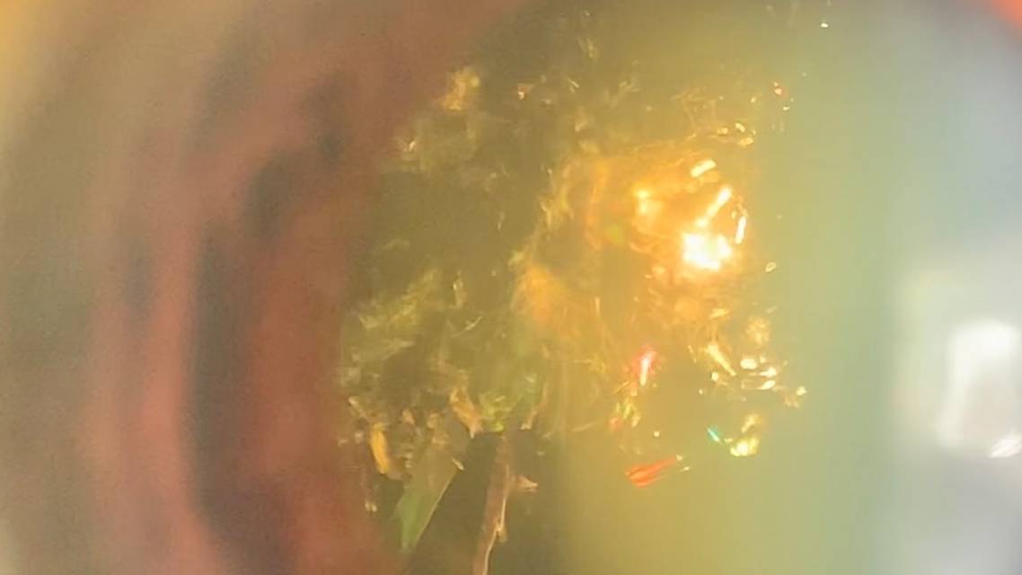 Christmas Tree Cataract