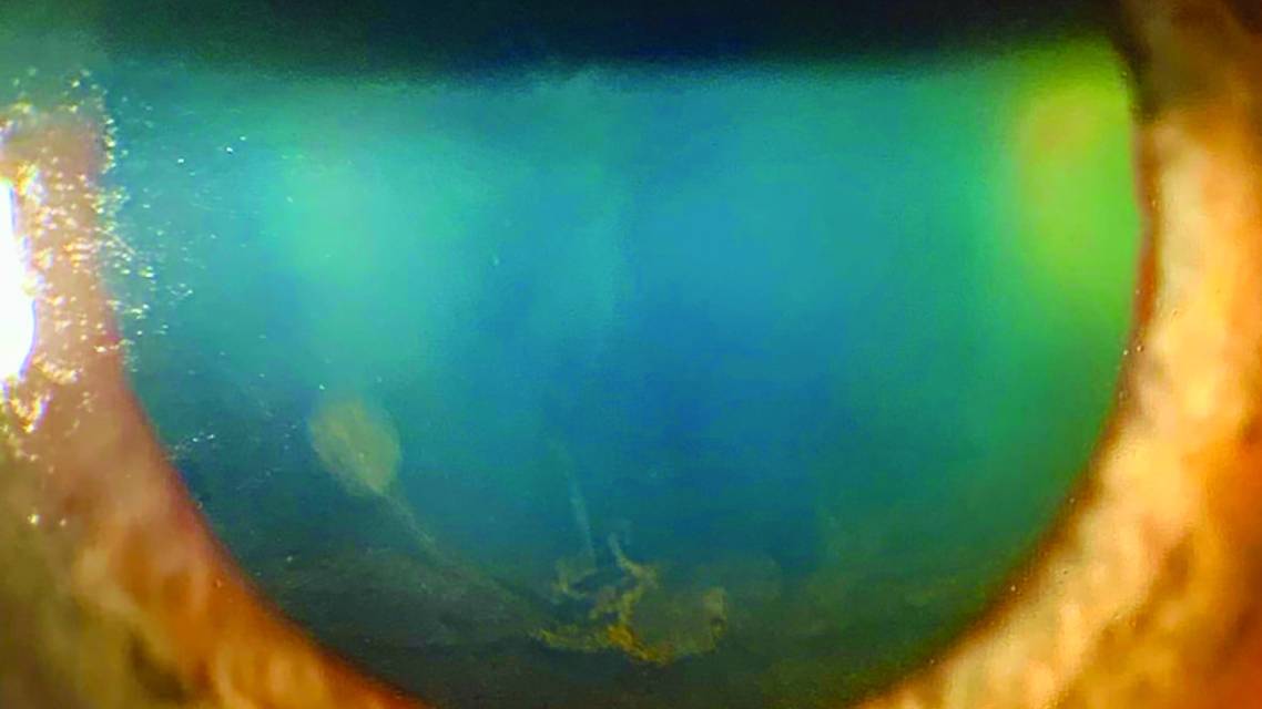 The Expanding Differential of Corneal Verticillata