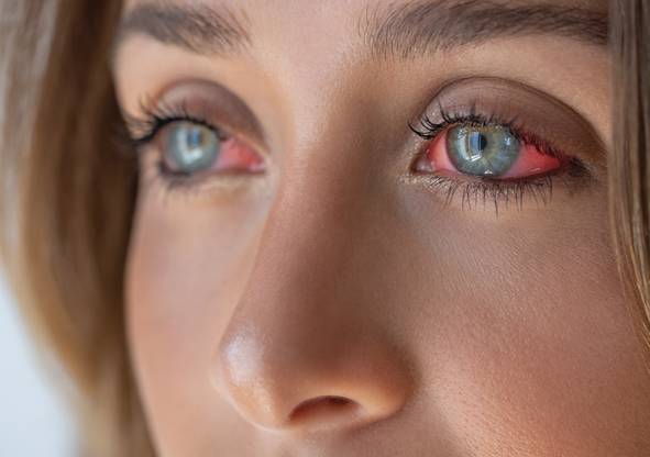 The Role of Inflammation and Immune Response in Dry Eye