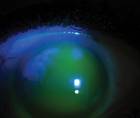 Treating Ocular Surface Disease With Scleral Lenses