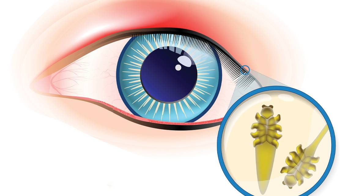 Demodex Friend or Foe