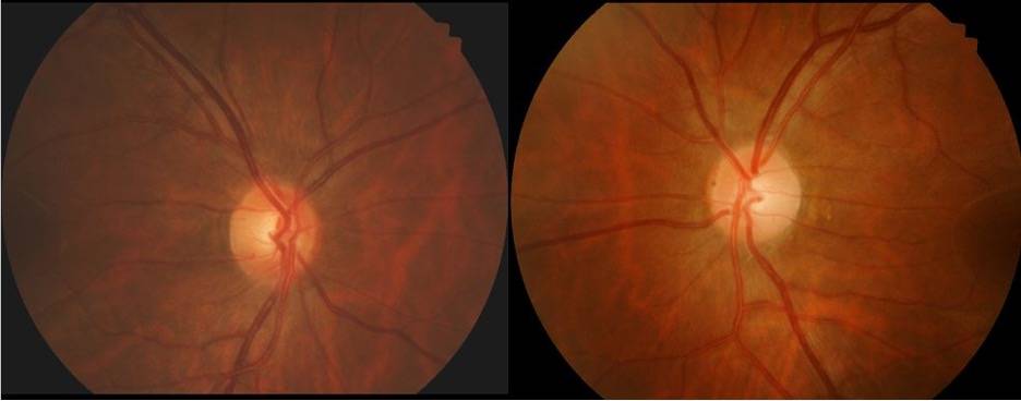 Ocular Effects of Pituitary Tumor
