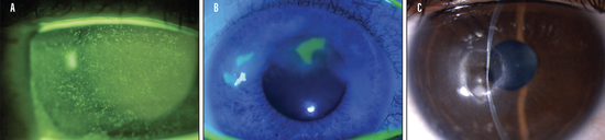 Does My Dry Eye Patient Have Stage 1 Neurotrophic Kera...