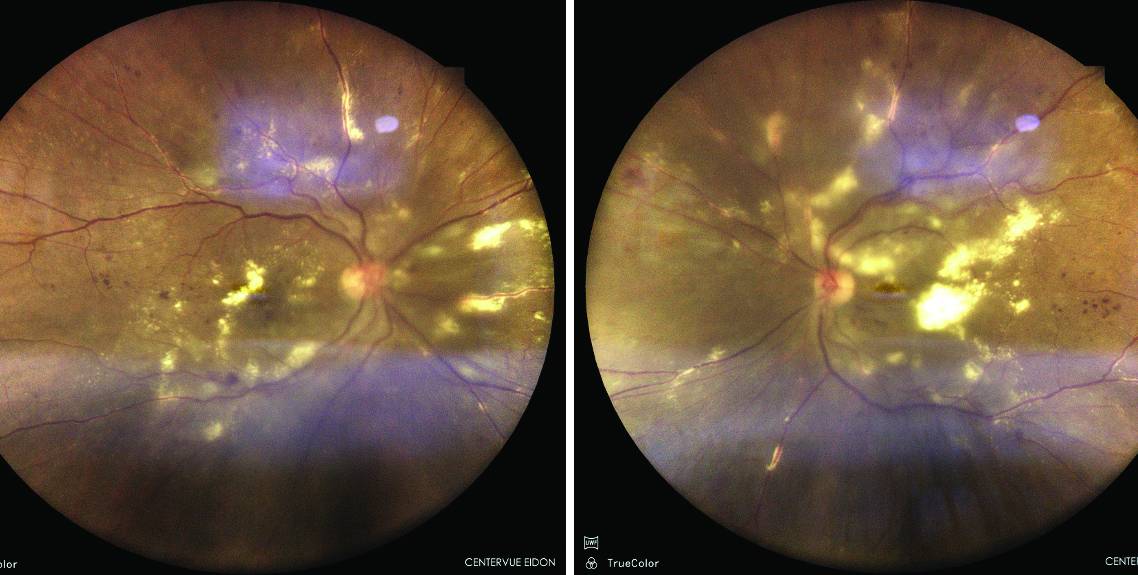 retina image
