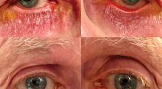 Ectropion in the Setting of Glaucoma