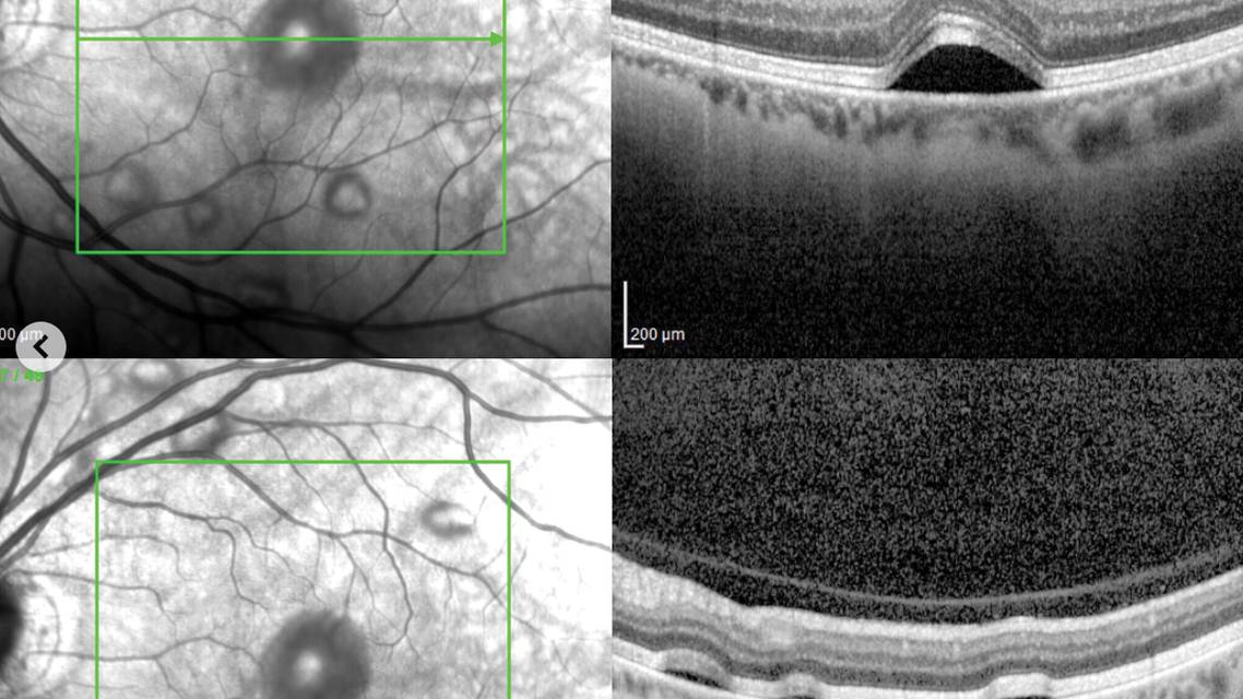 MEK Inhibitors and the Eye