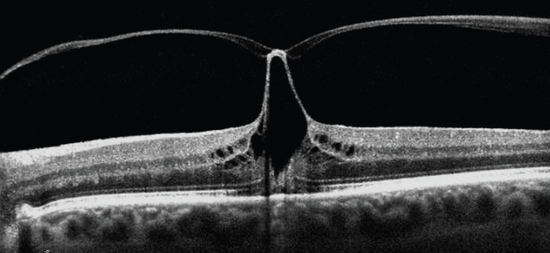 Know Your Vitreomacular Interface Disorders