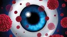 Case Report Ocular Melanoma