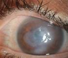 Mycobacterial Ocular Infections
