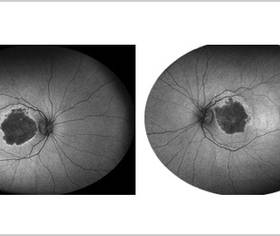 Geographic Atrophy Case Compendium - Modern Optometry