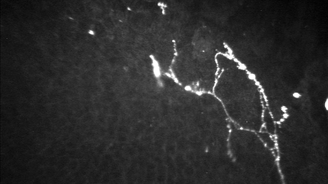 Neuropathic Eye Pain