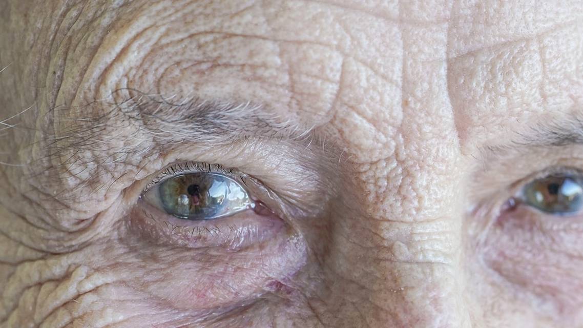 A Noninvasive Alternative to Cataract Surgery