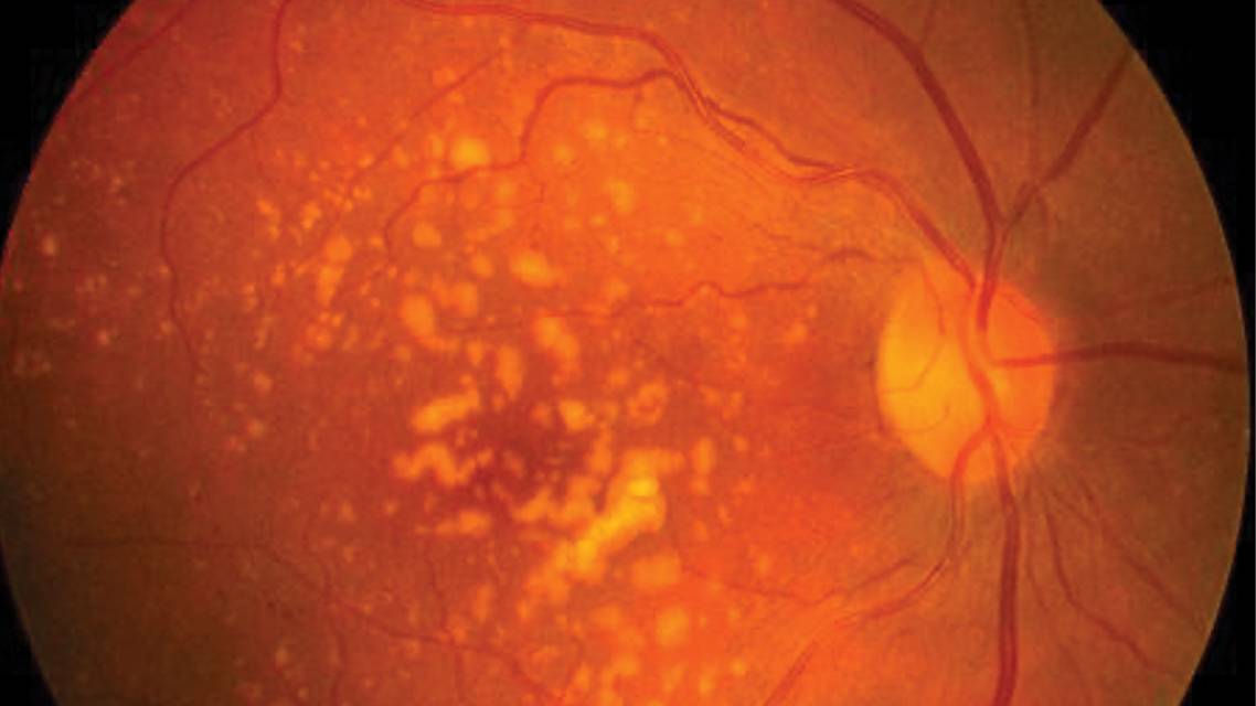 The Role of the Complement Pathway in AMD