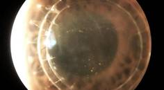 Corneal Graft Rejection Versus Failure