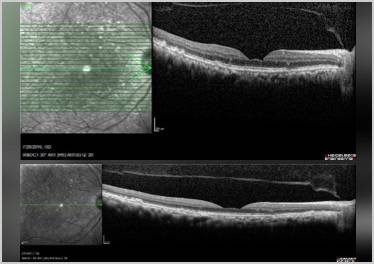 GA Case Compendium Challenges in Patient Education and Treatment Decision Making for Geographic Atrophy