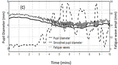 Supra Threshold Testing Is It Time to Rethink Perimetry