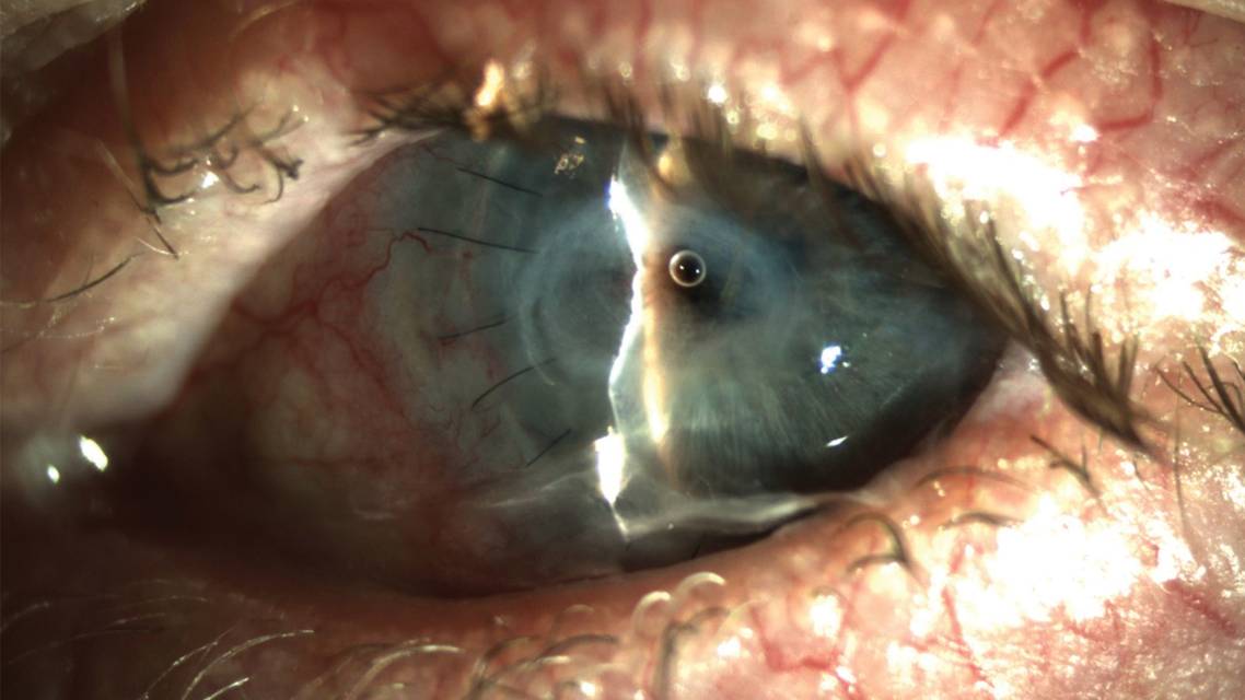 Neurotrophic Keratopathy A Practical Approach to Diagnosis and Management