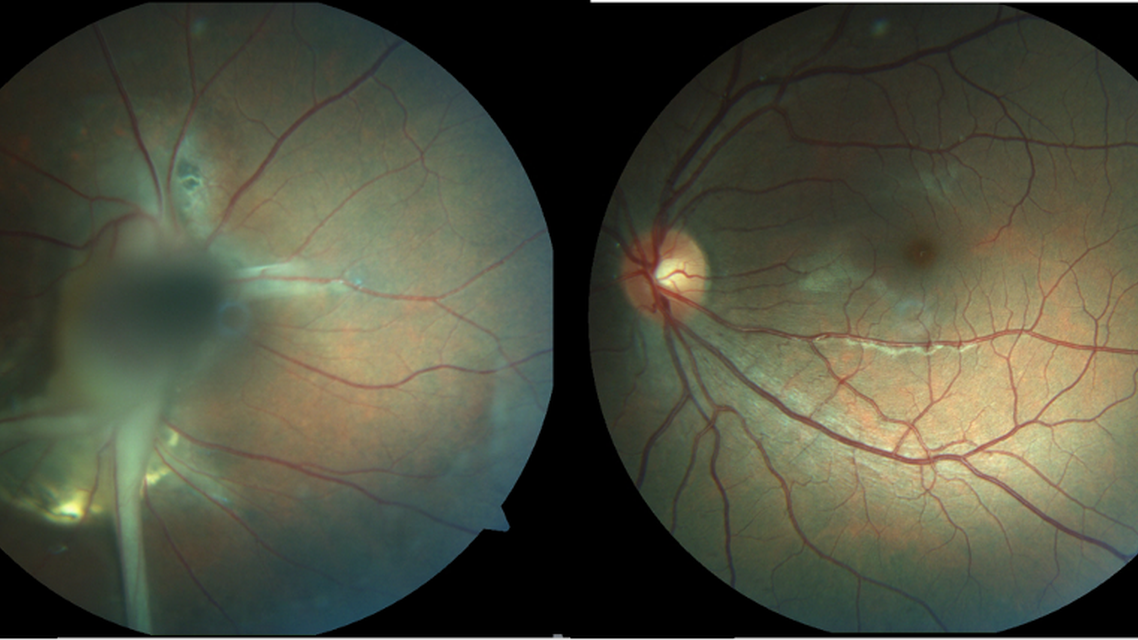 Persistent Fetal Vasculature