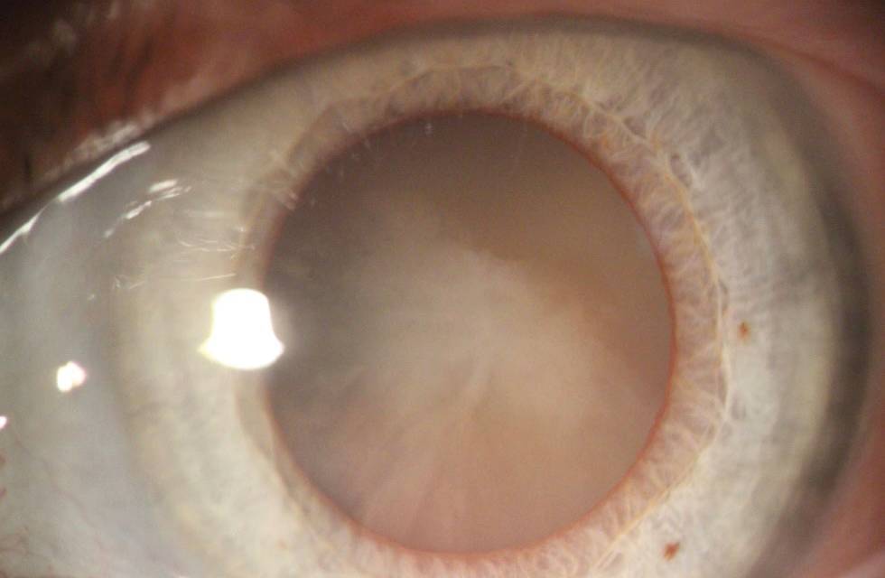 cataract