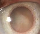 cataract