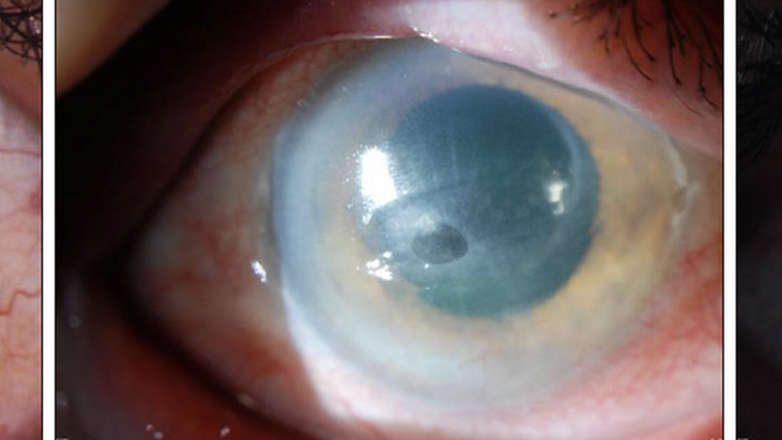 Update on the Zoster Eye Disease Study