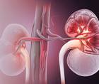 Ocular Complications of Renal Cancer