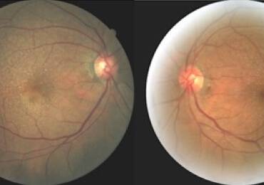 GA Case Compendium  Multimodal Imaging for Following Geographic Atrophy Over Time