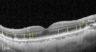 Study: Blinding Eye Disease Strongly Associated With Serious Forms of Cardiovascular Disease image