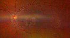 Collaborative Case 007 Cracked Egg