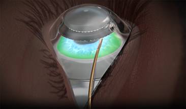 Johnson & Johnson Invests in Refractive Technology Start-Up TECLens image