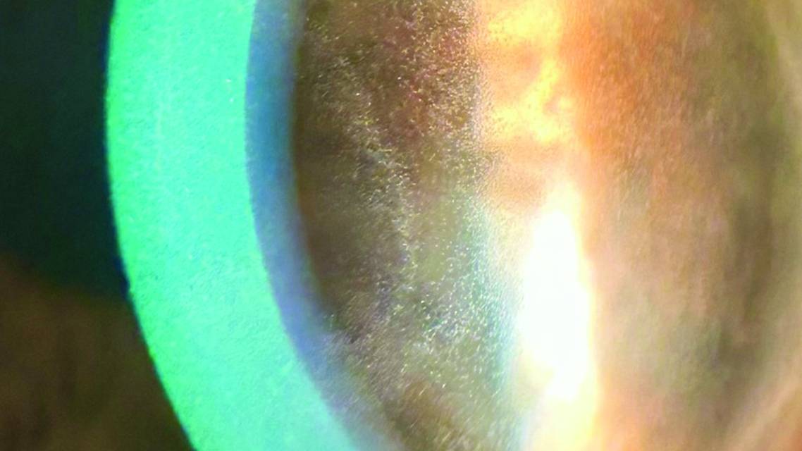 microcytic keratopathy in a patient who underwent Elahere therapy