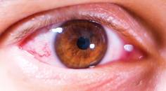 An Updated Overview of Inflammatory Dry Eye