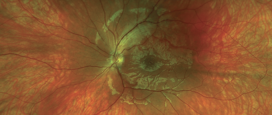 Retinal Splitting Lickety-Split Retina