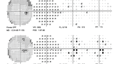 Ethambutol Toxic Optic Neuropathy