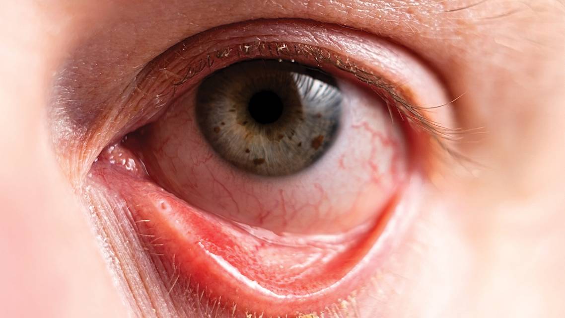 When Blepharitis InterferesWith Contact Lens Wear