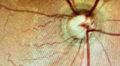 Optic Nerve Hemorrhages and Glaucoma