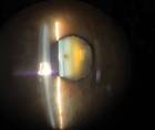 Cataract Surgery