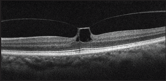 Vmt Classification Putting the “V” in Vitreomacular Traction