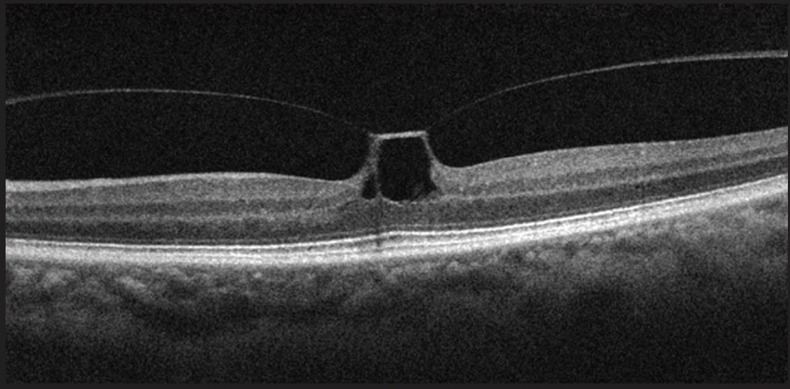 Putting the V in Vitreomacular Traction