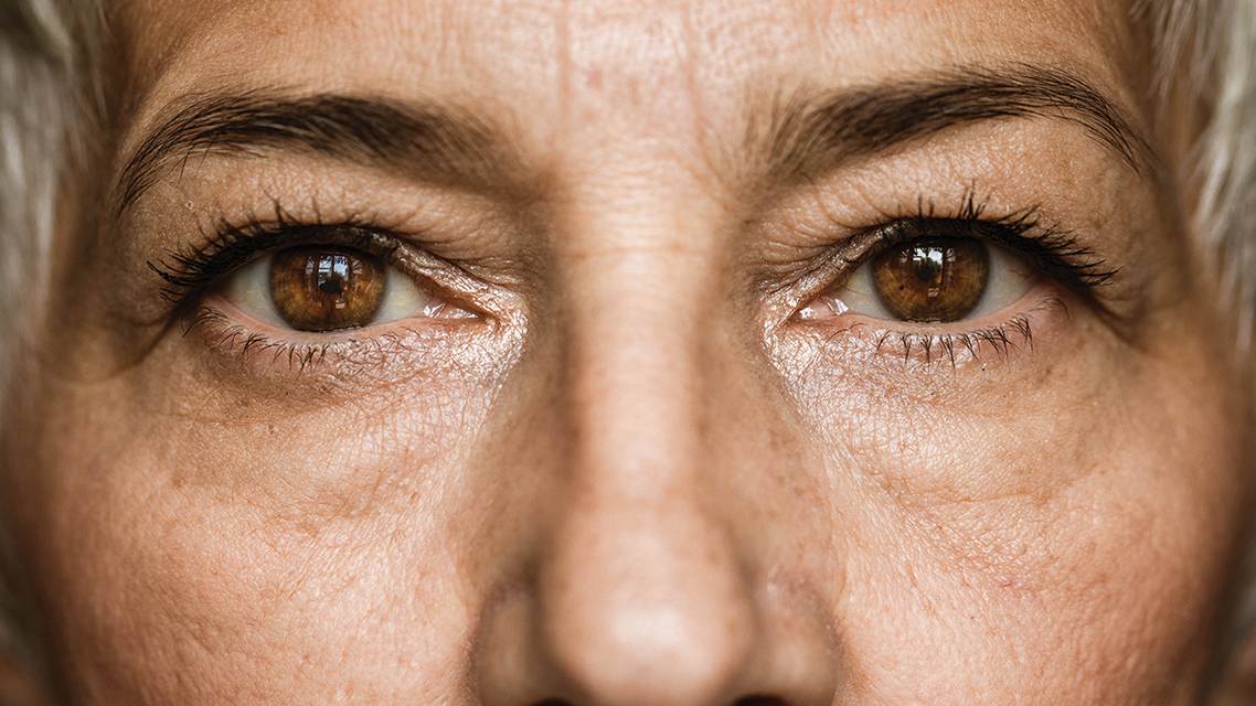 Ocular Surface Dryness in Women