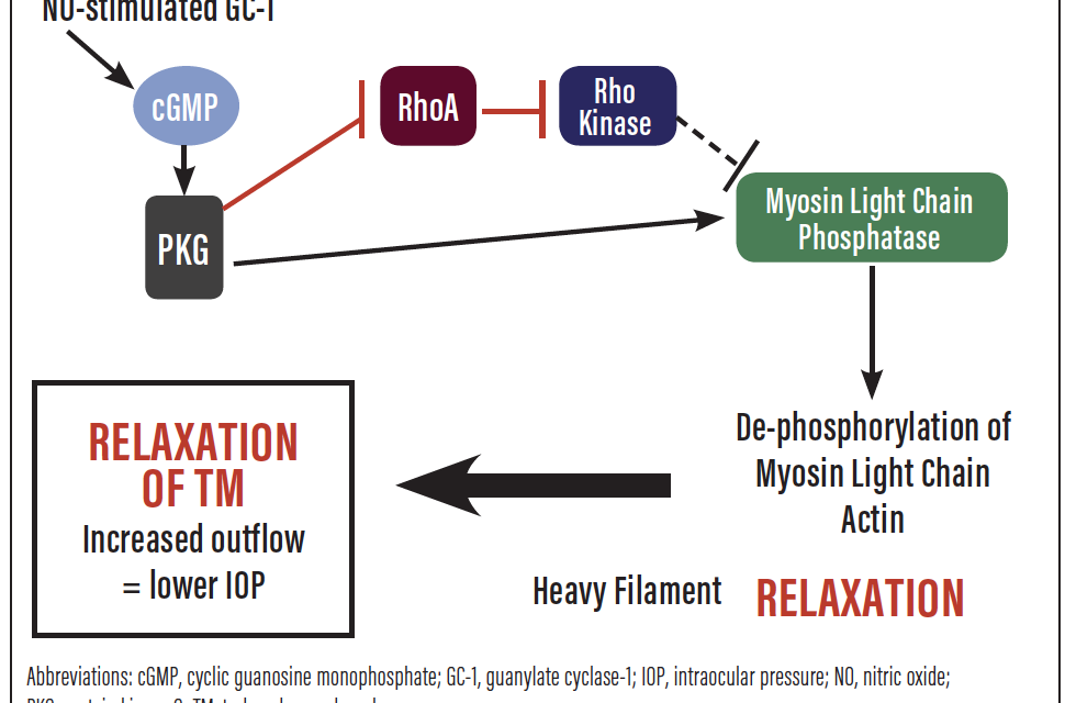 Current and Future Glaucoma Management An Update on Existing Options and the Therapeutic Pipeline
