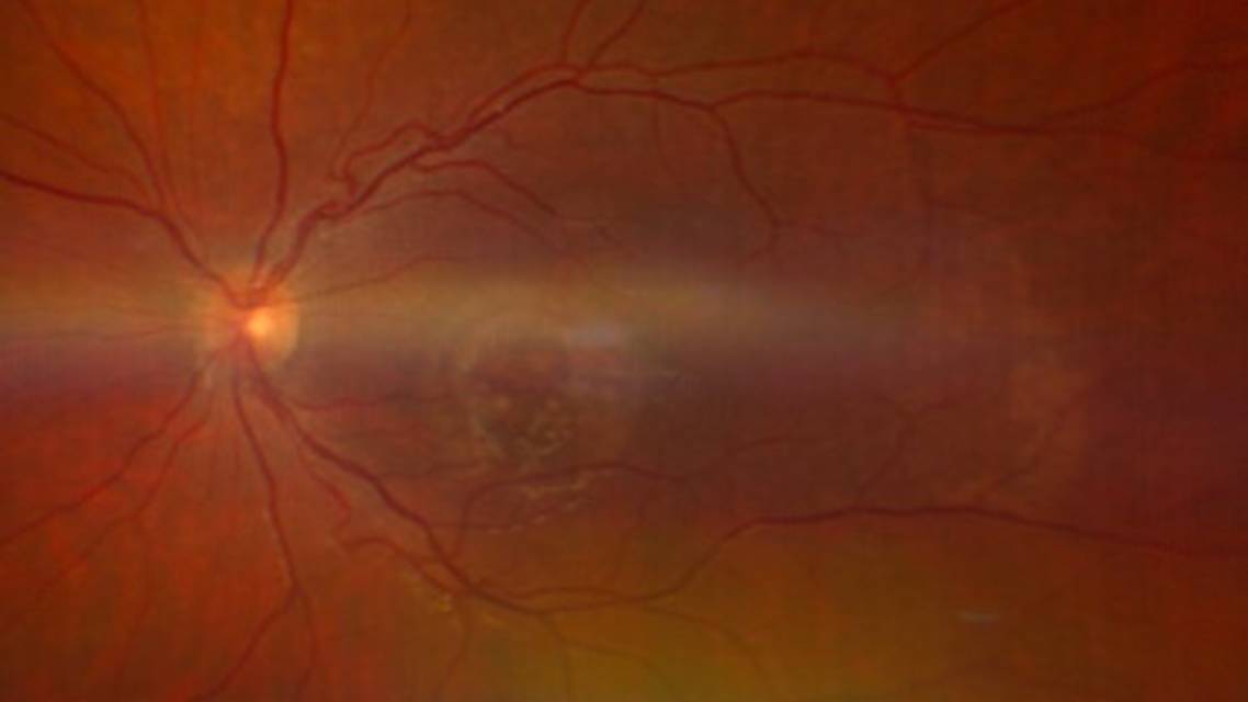 Collaborative Case 007 Cracked Egg