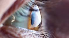 DupilumabAssociated Keratoconjunctivitis