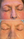 Figure. This patient presented with facial erythema and telangiectasia (top). After undergoing IPL, marked improvement was seen (bottom).