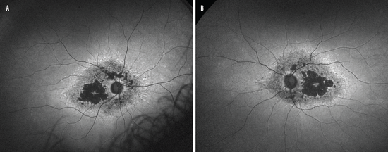 Stargardt Retinal Dystrophy - Modern Optometry
