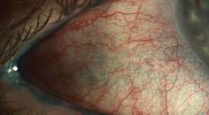 Whats Your Dry Eye Acumen