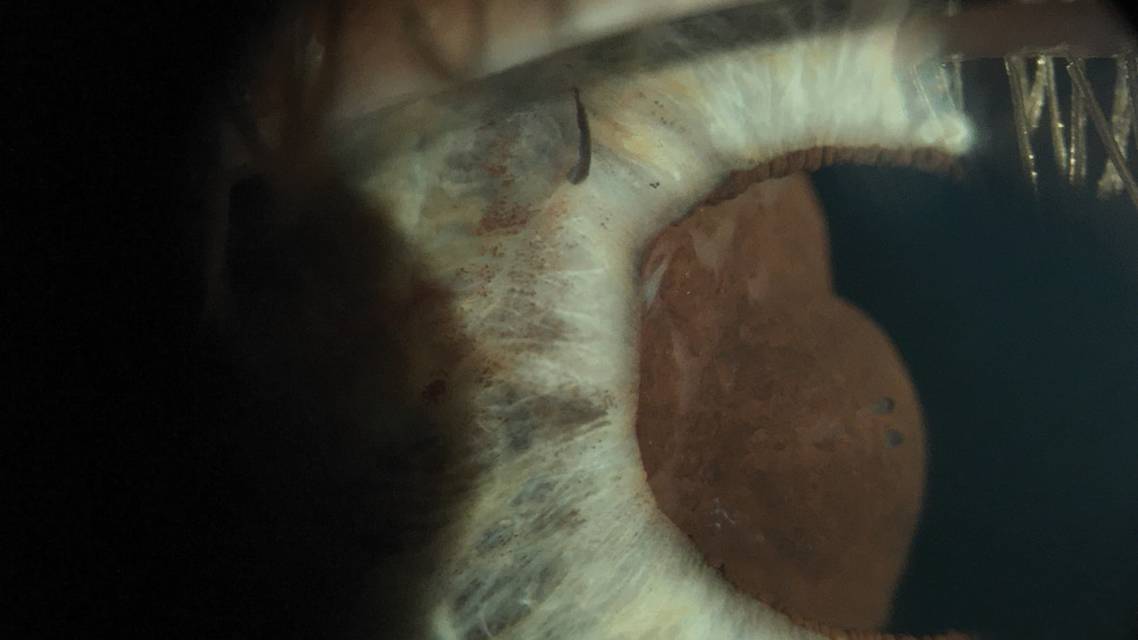 Suspected Uveal Melanoma