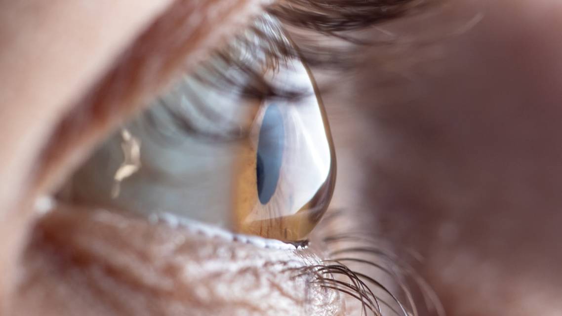 Managing Keratoconus With Scleral Lenses