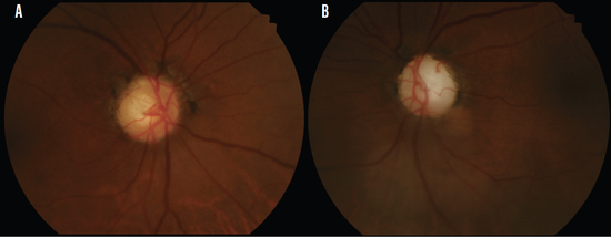 Visual Damage A Case of Multiple Visual Field Defects Secondary to G...