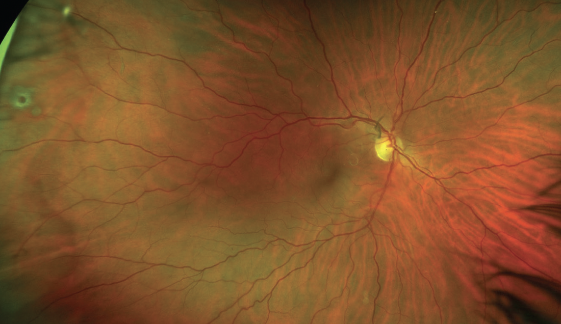 Optometry Floaters Beware the Floaters - Modern Optometry